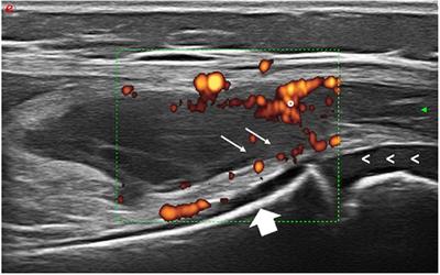 Case report: Prader–Willi syndrome and inflammatory arthritis—An important consideration